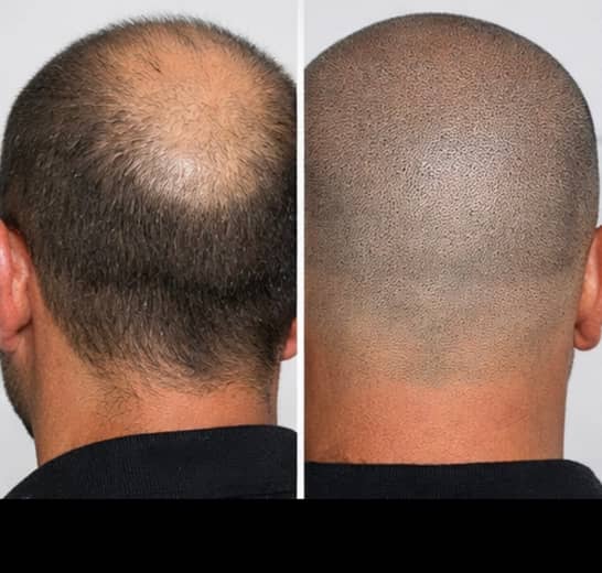 Before and after scalp micropigmentation adding even shading across a thinning crown viewed from behind on a male client at Kennedy SMP Studio