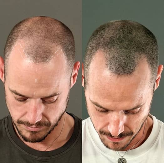 Before and after scalp micropigmentation rebuilding the look of density across the frontal hairline and temples on a male client at Kennedy SMP Studio