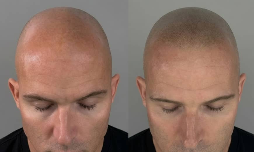 Before and after scalp micropigmentation rebuilding even density across a bald scalp with a soft, natural-looking hairline on a male client at Kennedy SMP Studio