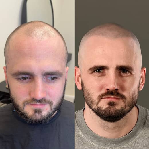 Before and after scalp micropigmentation creating a lower, fuller-looking hairline and denser front on a male client at Kennedy SMP Studio