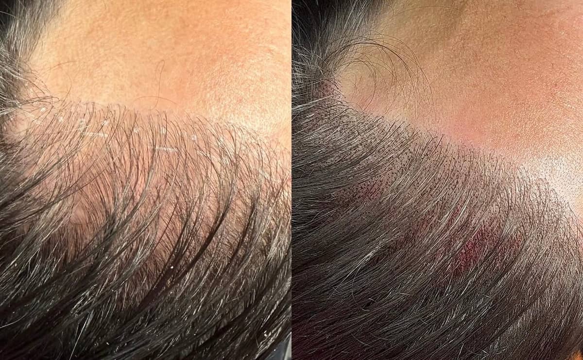 Close-up before and after of density scalp micropigmentation filling gaps along the hairline at Kennedy SMP Studio