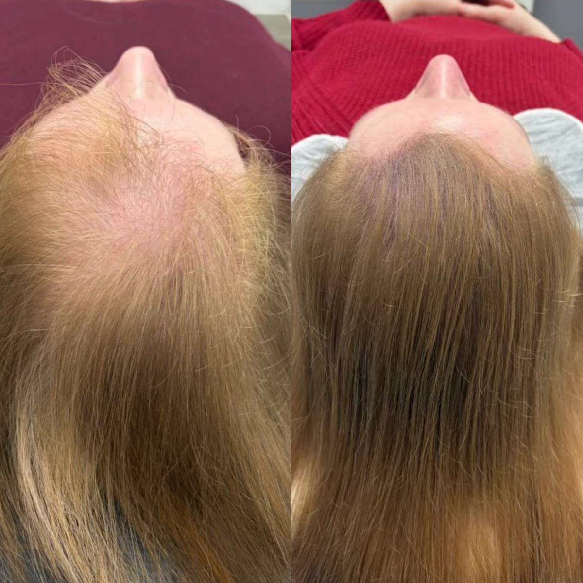 Before and after female scalp micropigmentation adding the appearance of density across a thinning crown and parting at Kennedy SMP Studio