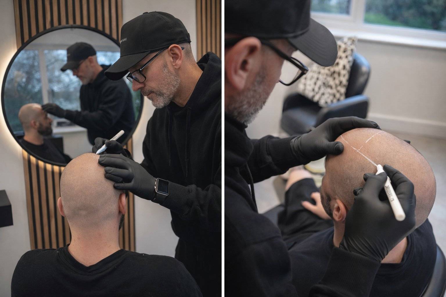 Mapping the hairline before a density scalp micropigmentation session