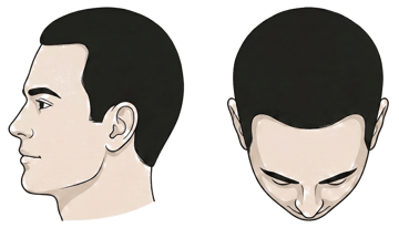 Norwood stage 1 illustration, side profile and top-down view: A full head of hair, no recession
