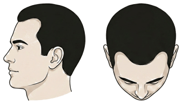 Norwood stage 2 illustration, side profile and top-down view: Slight, even recession at the temples