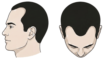 Norwood stage 3 illustration, side profile and top-down view: Early recession: deeper M or V notches at the temples