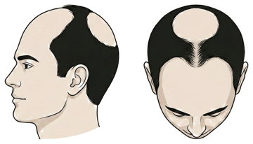 Norwood stage 5 illustration, side profile and top-down view: Larger front and crown, a narrow bridge between