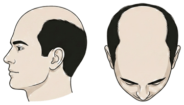 Norwood stage 6 illustration, side profile and top-down view: Front and crown merge, a horseshoe remains