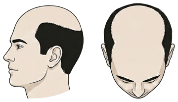 Norwood stage 7 illustration, side profile and top-down view: Only a narrow band around the sides and back