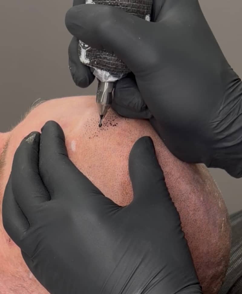 Close-up of scalp micropigmentation pigment being applied to the scalp at Kennedy SMP Studio