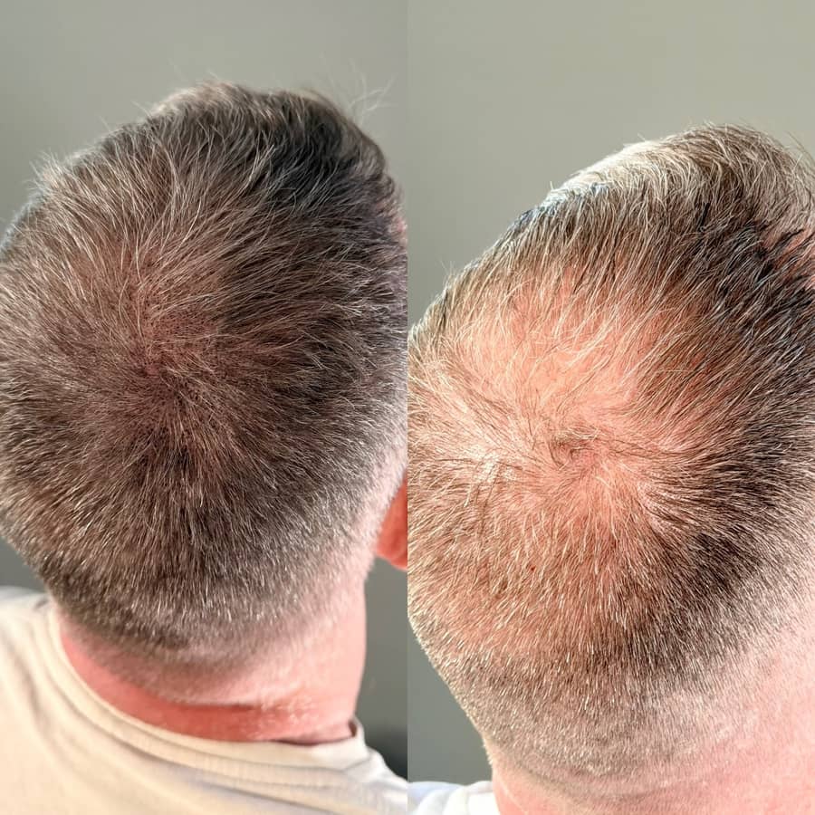Before and after scalp micropigmentation softening the look of a thinning crown on greying hair on a male client at Kennedy SMP Studio