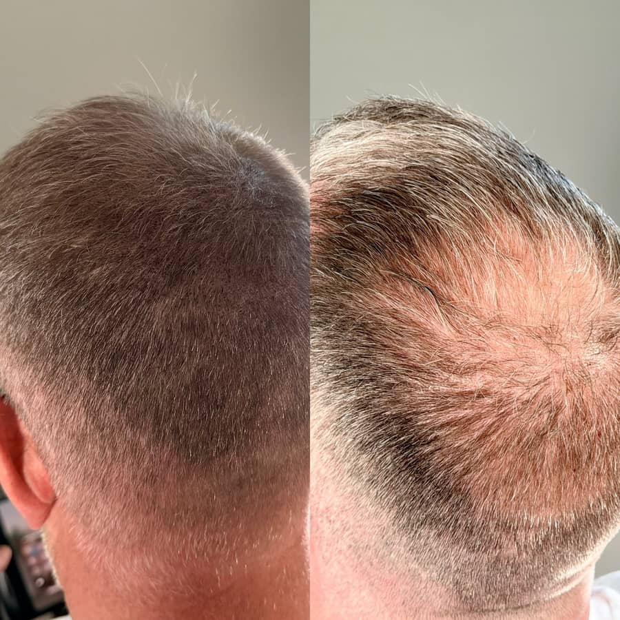 Before and after scalp micropigmentation reducing the contrast between hair and scalp across a thinning crown and mid-scalp on a male client at Kennedy SMP Studio