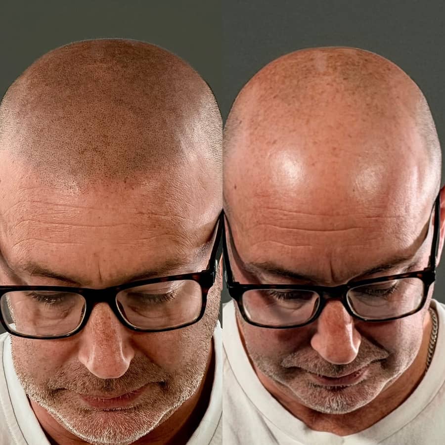 Before and after scalp micropigmentation adding even shading across a diffusely thinning scalp on a male client at Kennedy SMP Studio
