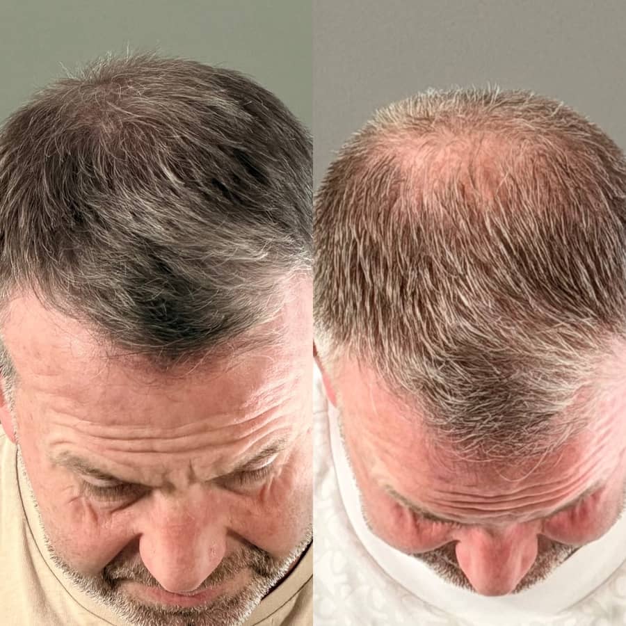 Before and after scalp micropigmentation recreating a fuller-looking hairline and front on greying hair on a male client at Kennedy SMP Studio