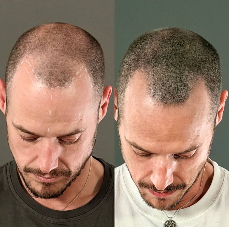 Before and after scalp micropigmentation rebuilding the look of density across the frontal hairline and temples on a male client at Kennedy SMP Studio