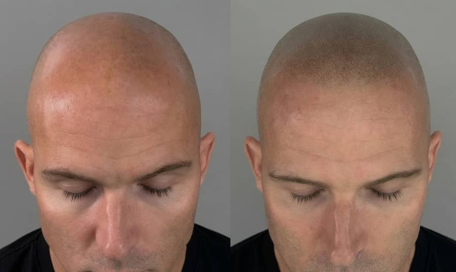 Before and after scalp micropigmentation rebuilding even density across a bald scalp with a soft, natural-looking hairline on a male client at Kennedy SMP Studio