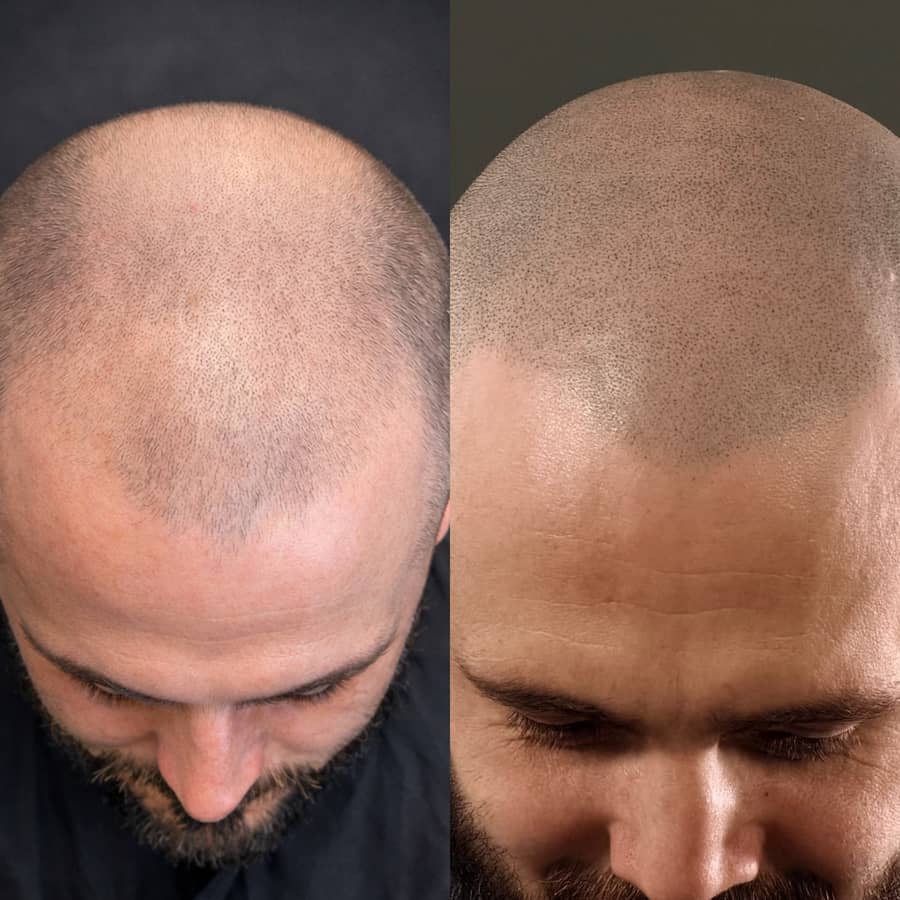 Before and after scalp micropigmentation adding the look of density across a thinning top and hairline on a male client at Kennedy SMP Studio